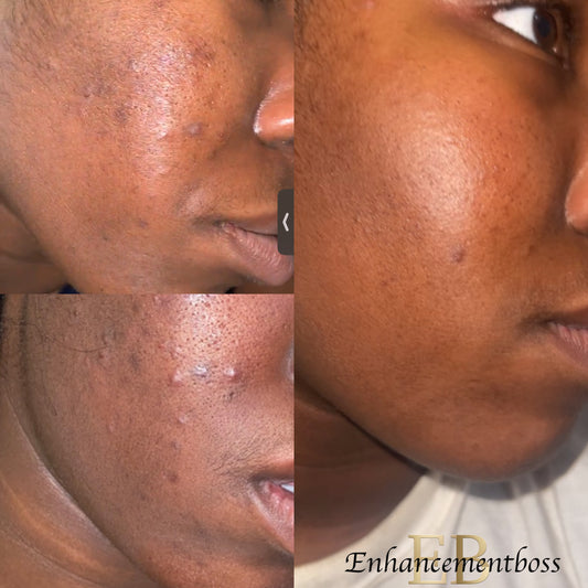 Microneedling